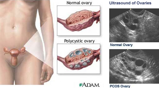 imagine cu sindromul ovarian